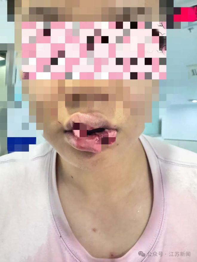 男子與愛寵親密互動發(fā)生意外，嘴唇被咬掉引發(fā)教訓(xùn)與反思