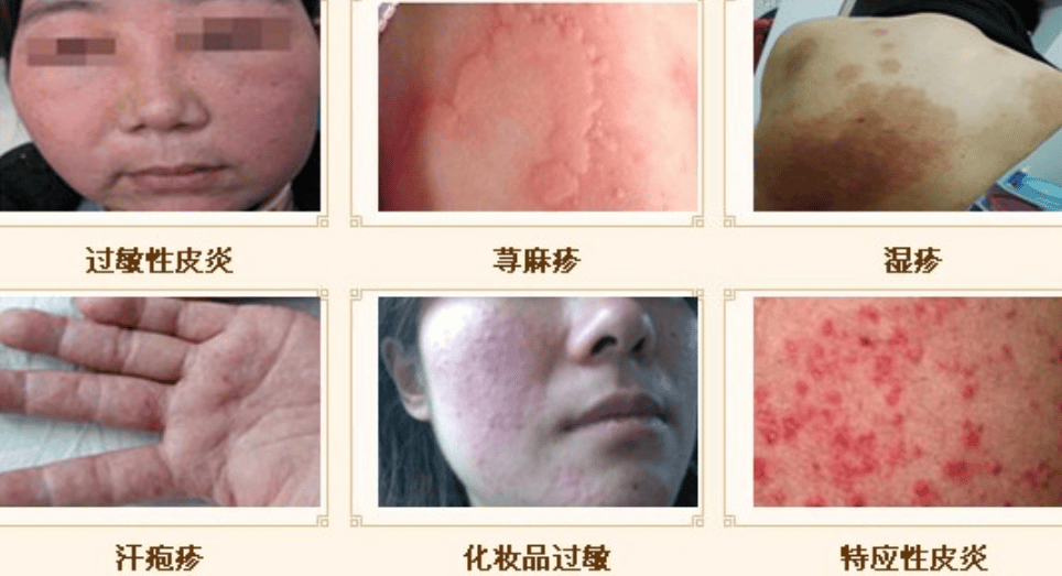 家中如何識(shí)別與處理過(guò)敏反應(yīng)的方法指南
