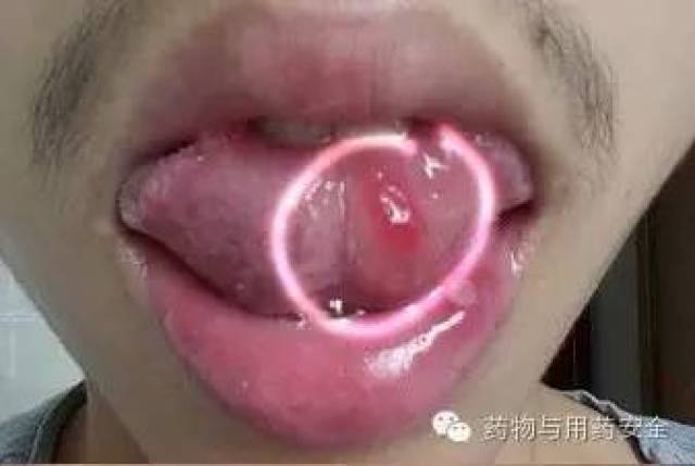 口腔潰瘍疼痛急救指南，應(yīng)對(duì)處理全攻略