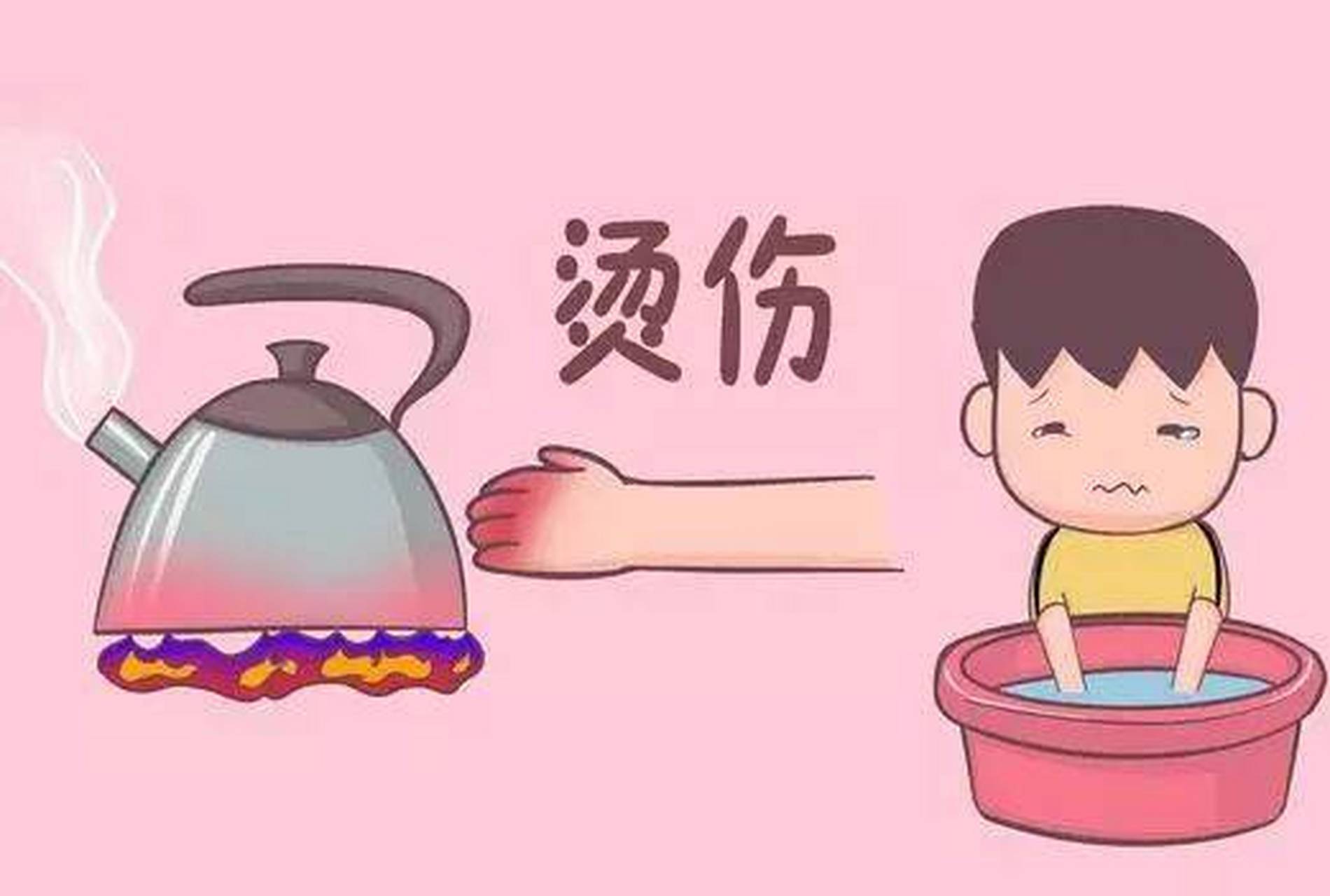 家庭急救指南，小孩燙傷處理步驟