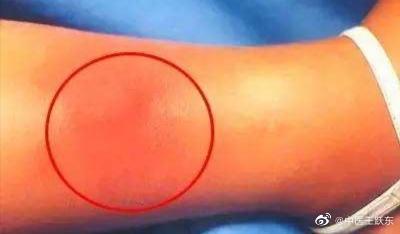 中醫(yī)治療頭痛的常見(jiàn)方法簡(jiǎn)述